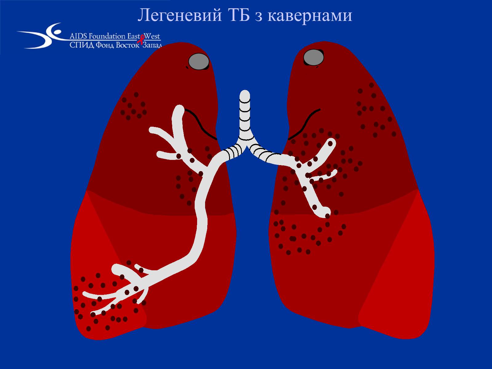 Презентація на тему «Туберкульоз» (варіант 1) - Слайд #25