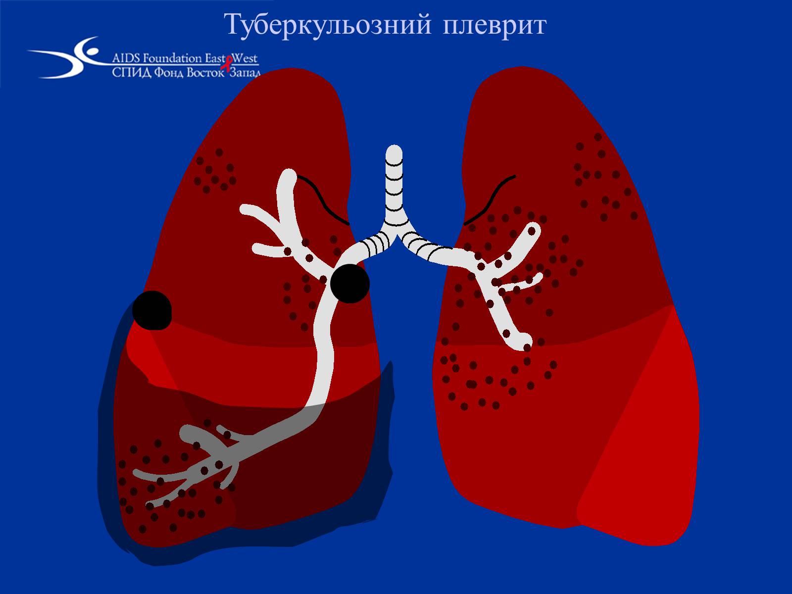Презентація на тему «Туберкульоз» (варіант 1) - Слайд #26