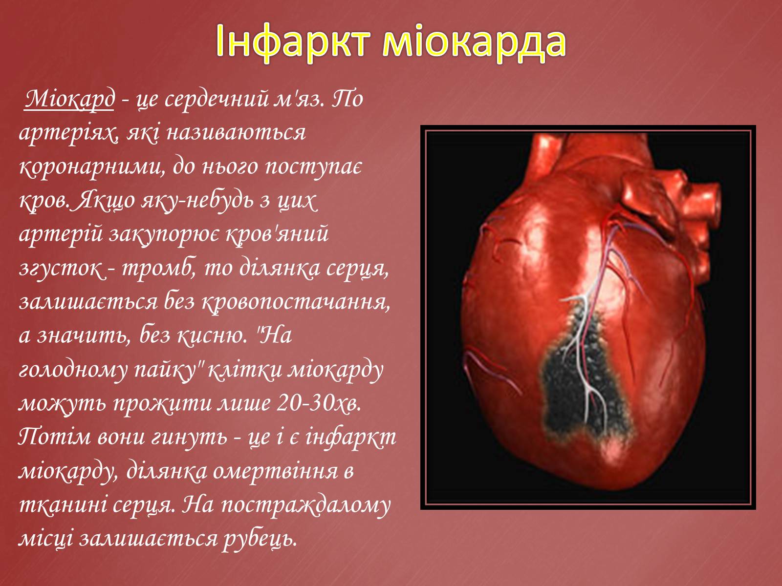 Презентація на тему «Захворювання серцево-судинної системи» (варіант 2) - Слайд #11