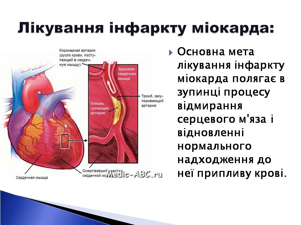Презентація на тему «Інфаркт міокарда» (варіант 2) - Слайд #9