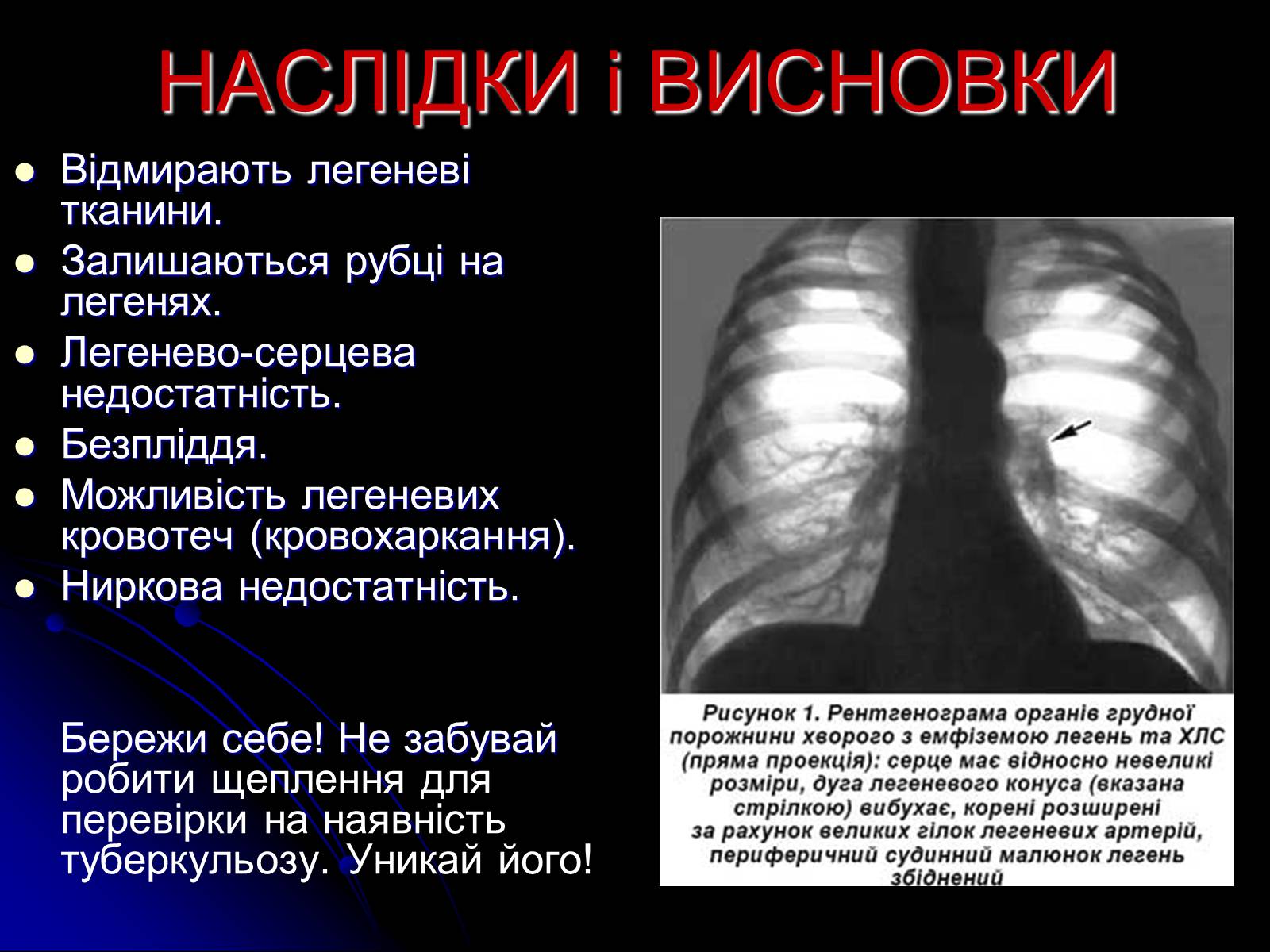 Презентація на тему «Туберкульоз» (варіант 4) - Слайд #11