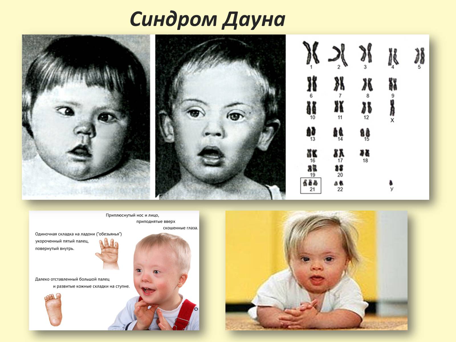 Степени дауна. Мозаицизм синдрома Дауна. Признаки синдрома Дауна лицо. Мозаицизм синдрома Дауна хромосомы.