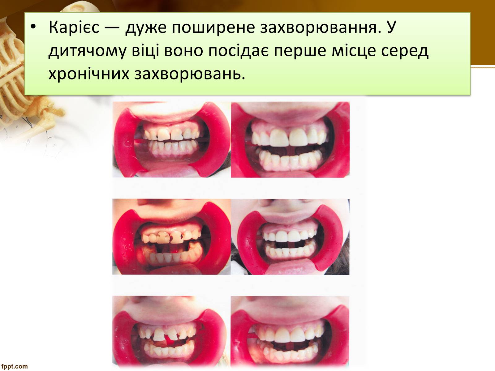 Презентація на тему «Бережіть свої зуби» - Слайд #11