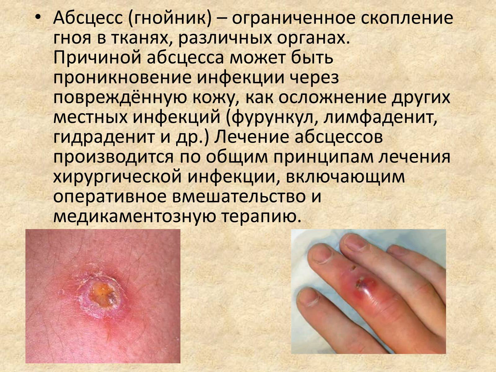 Презентація на тему «Гнойные заболевания кожи и подкожной клетчатки» - Слайд #7