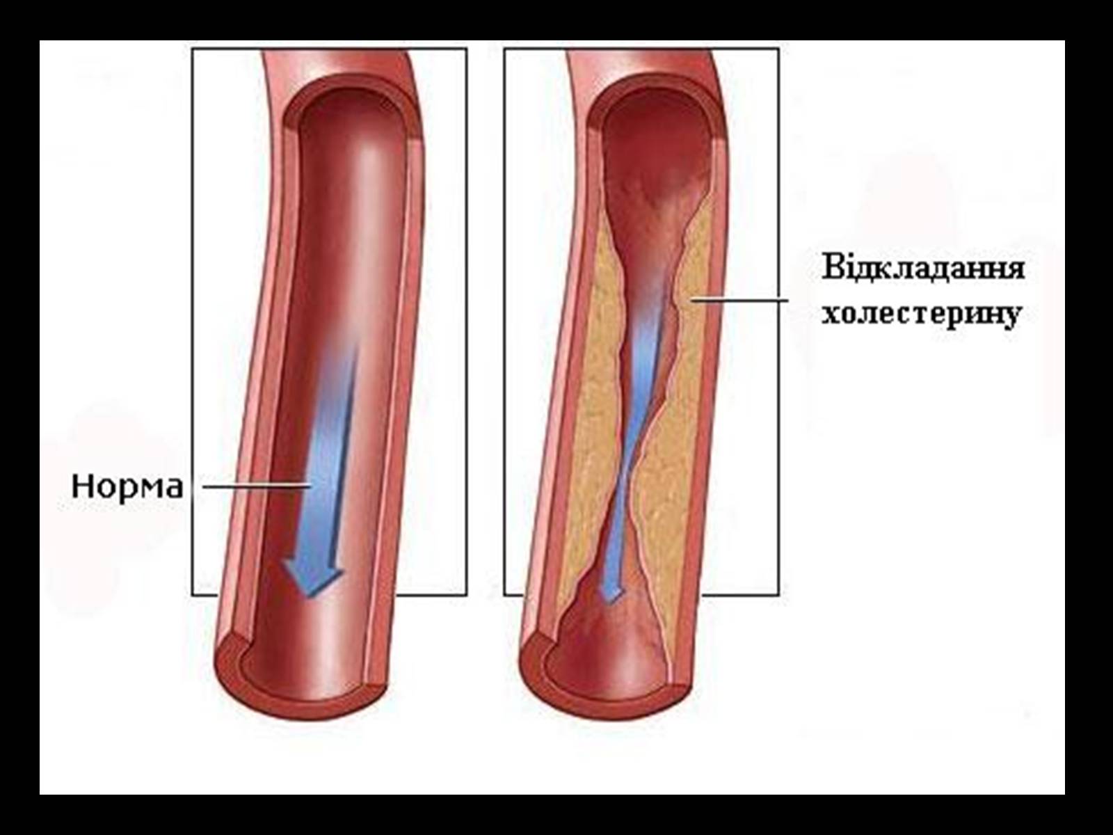 Презентація на тему «Методи відновлення кровообігу в уражених атеросклерозом коронарних артеріях при ішемічній хворобі серця» - Слайд #5