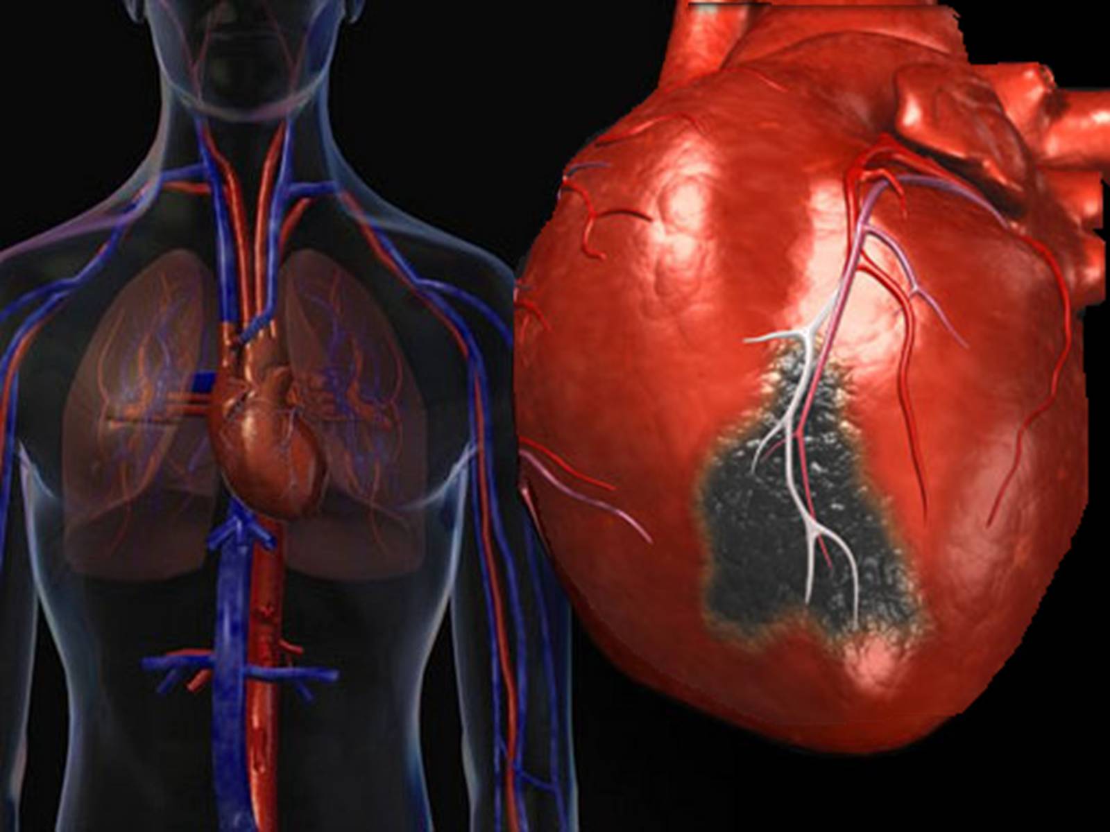 Презентація на тему «Методи відновлення кровообігу в уражених атеросклерозом коронарних артеріях при ішемічній хворобі серця» - Слайд #9