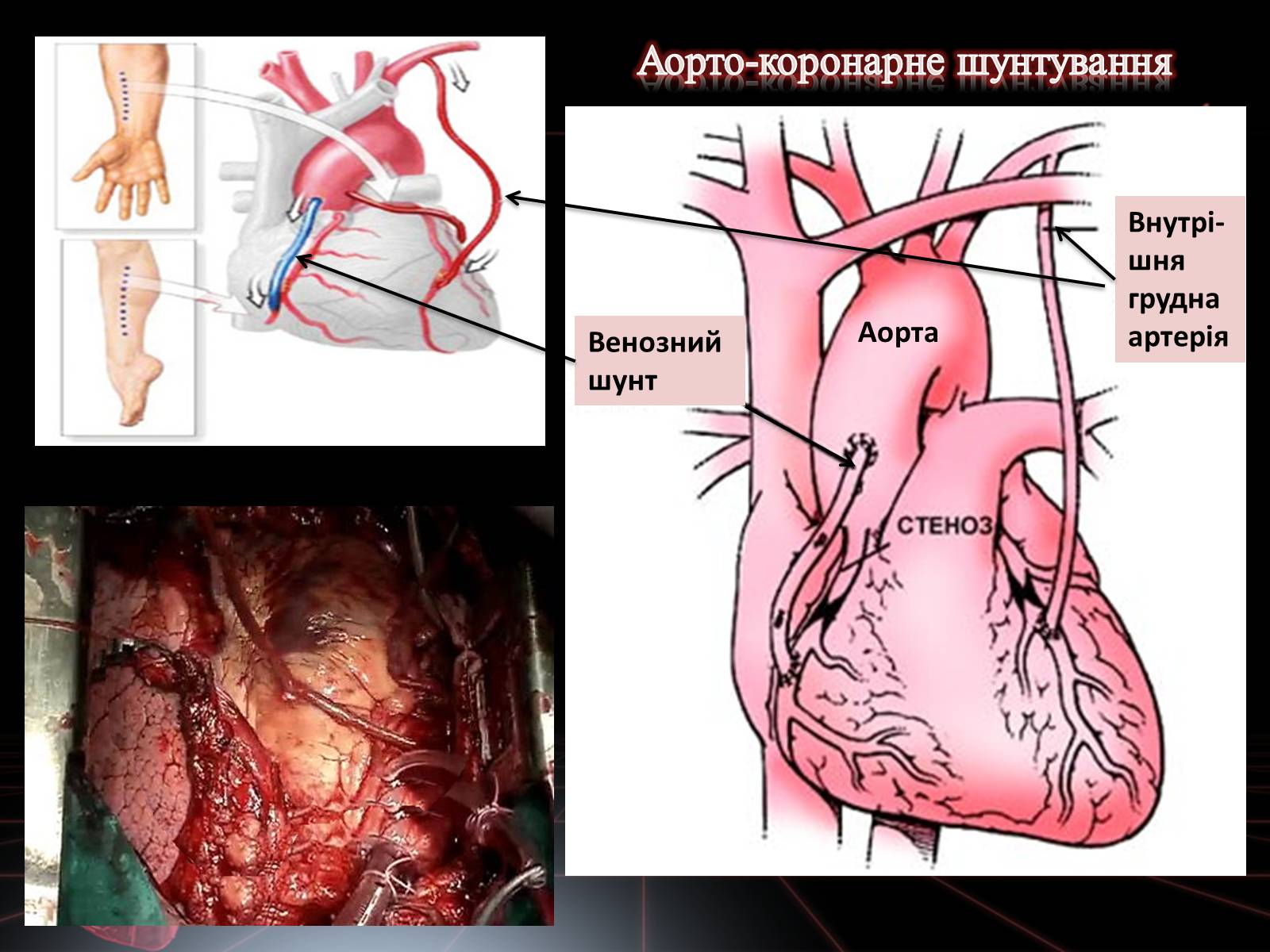 Презентація на тему «Методи відновлення кровообігу в уражених атеросклерозом коронарних артеріях при ішемічній хворобі серця» - Слайд #15