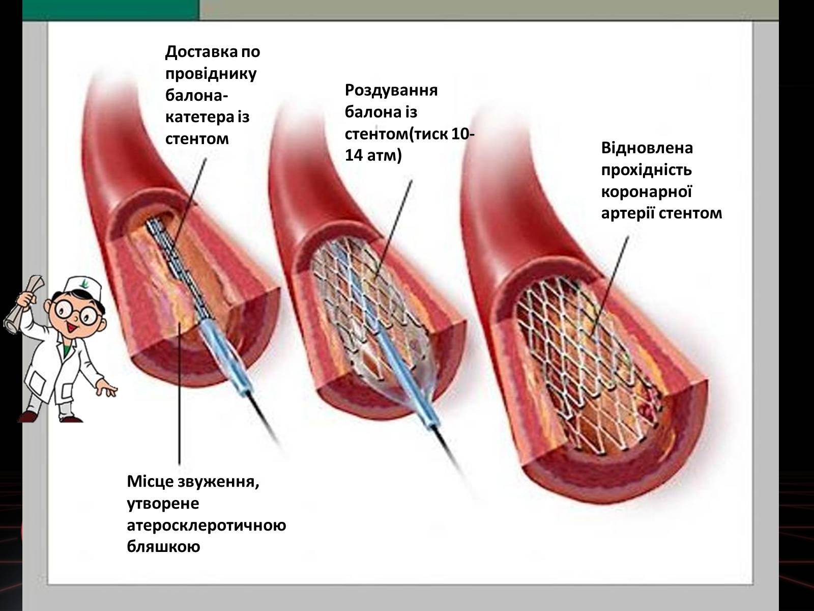 Презентація на тему «Методи відновлення кровообігу в уражених атеросклерозом коронарних артеріях при ішемічній хворобі серця» - Слайд #18