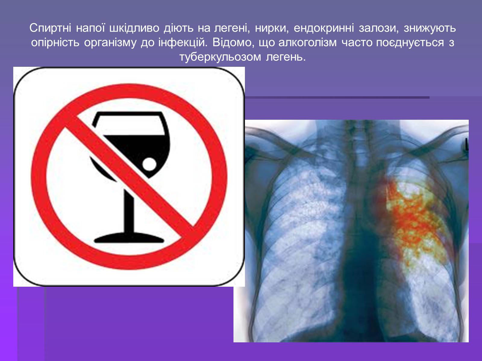 Презентація на тему «Алкоголізм» (варіант 2) - Слайд #10