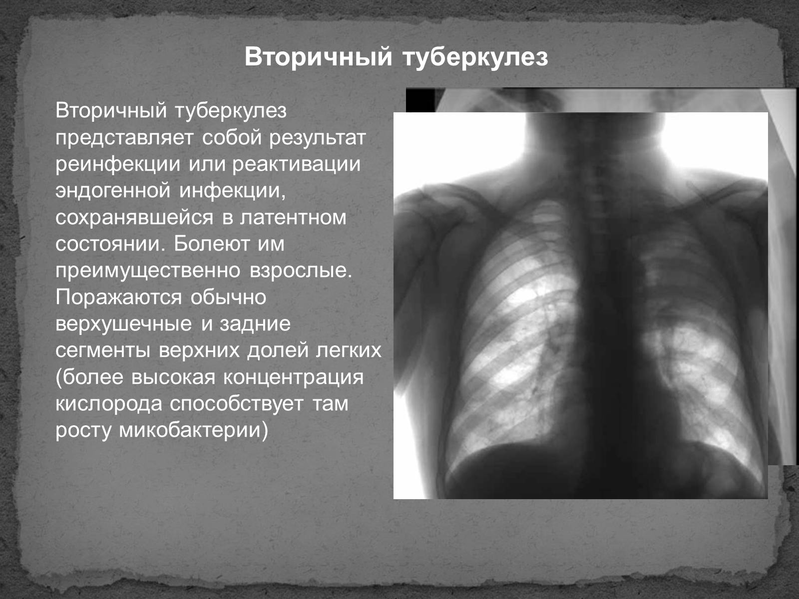 Вторичный туберкулез