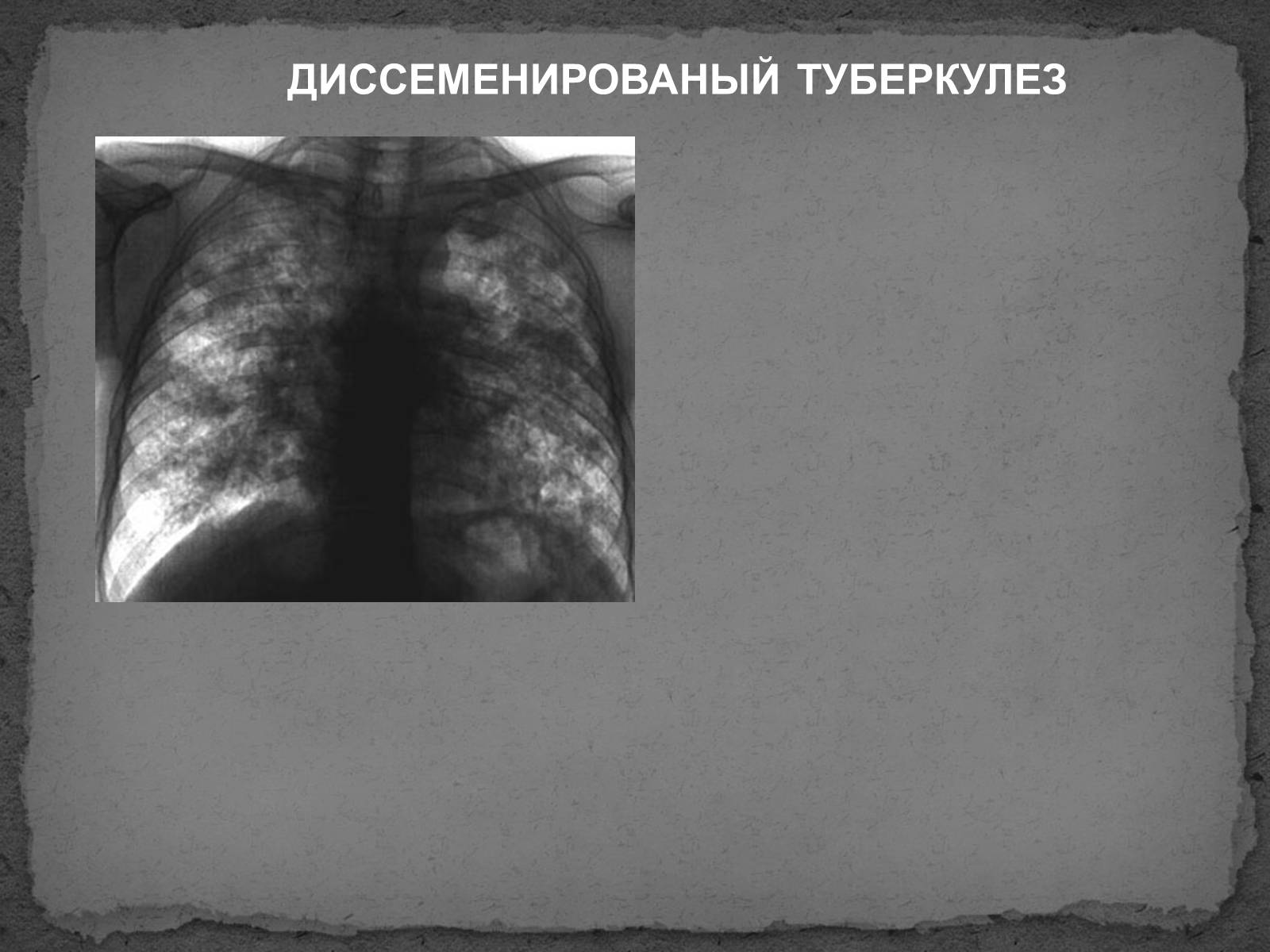 Презентація на тему «Туберкулез» (варіант 1) - Слайд #7