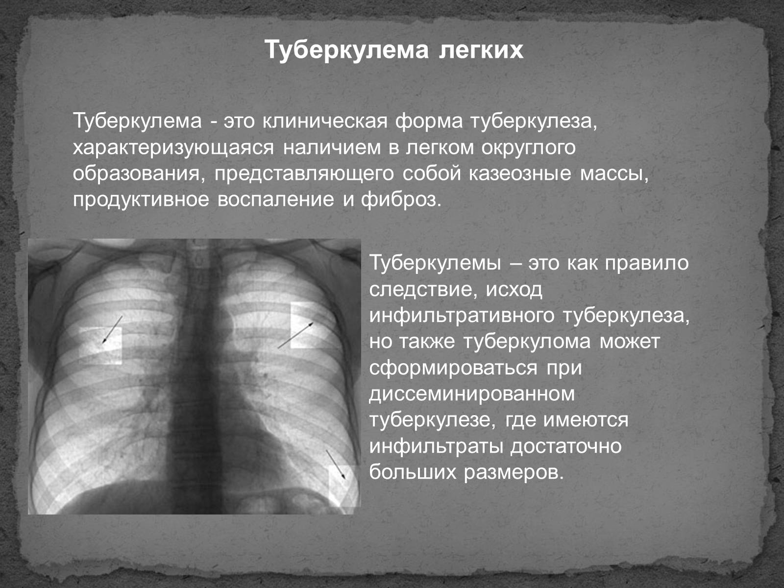 Рентген туберкулез туберкулема