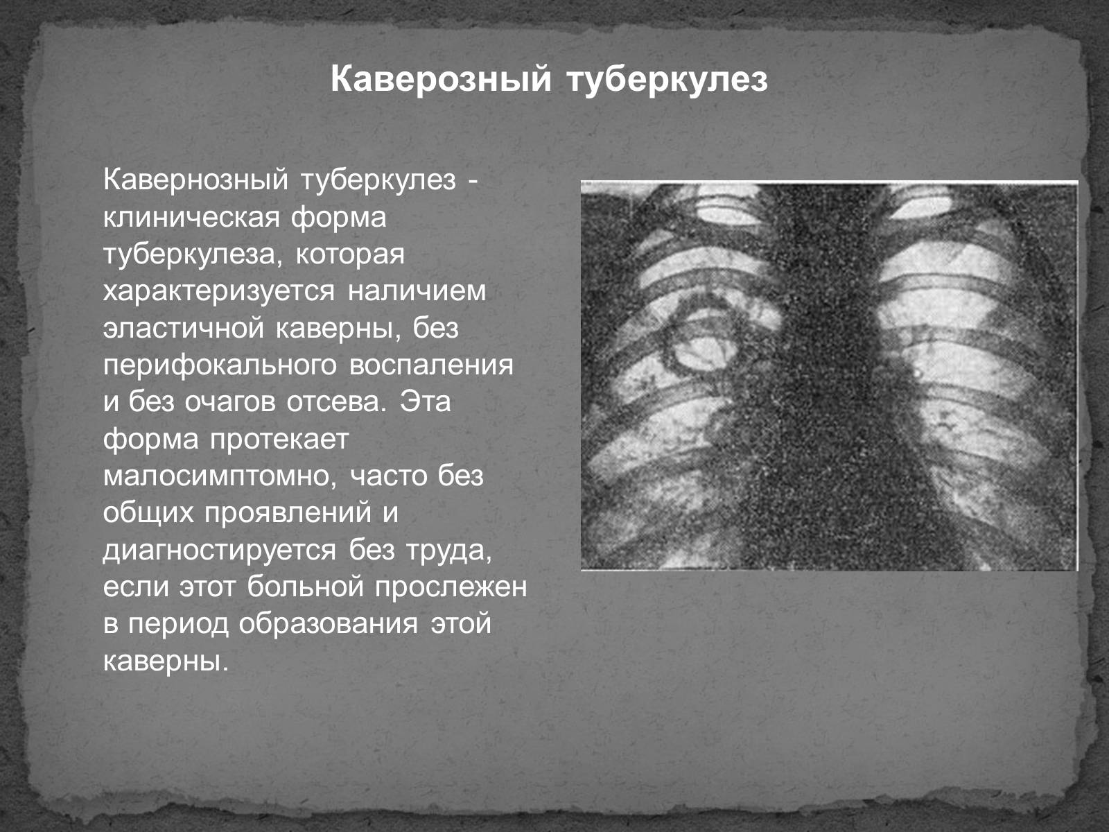 Кавернозная форма туберкулеза легких рентген
