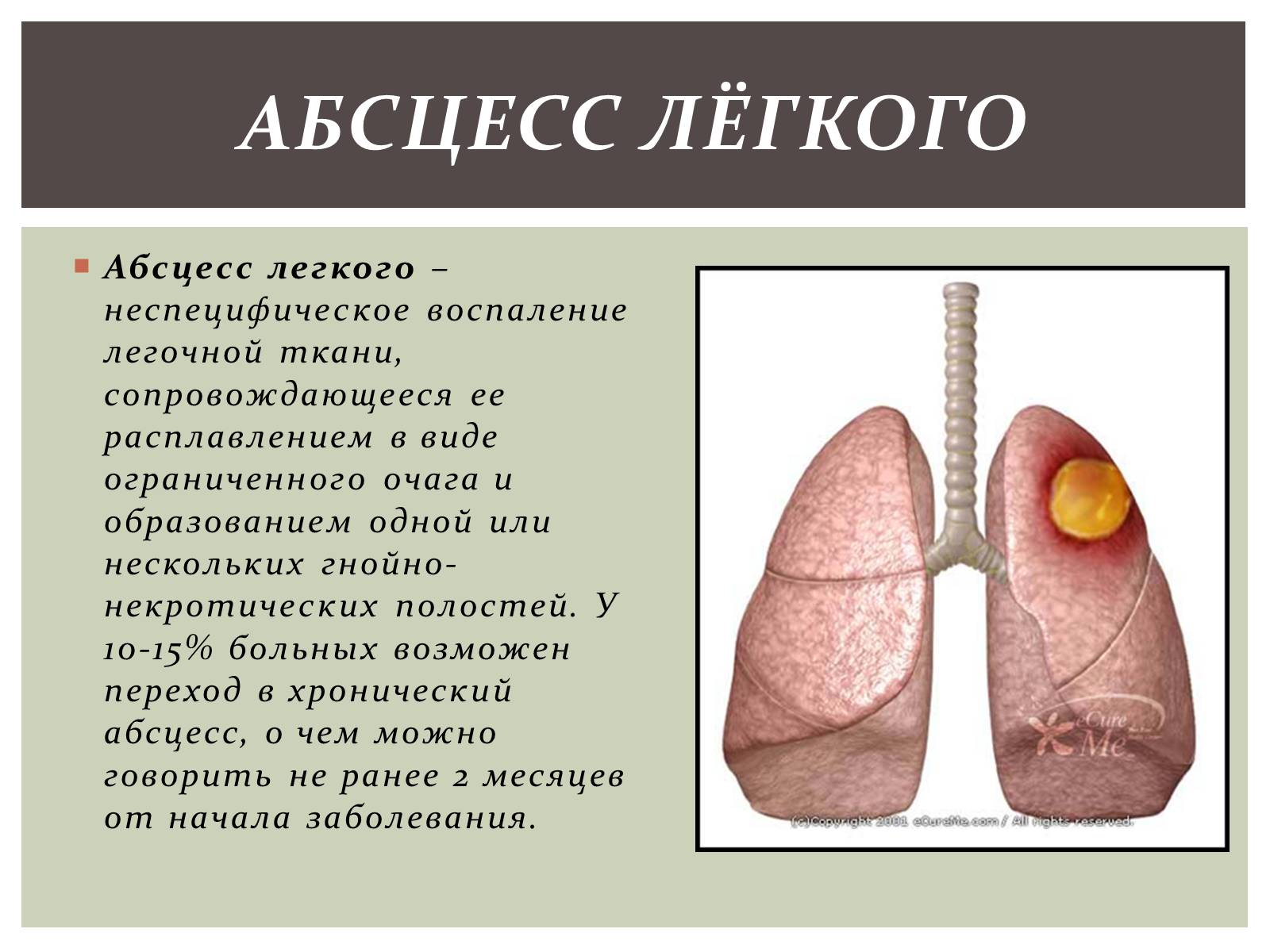 Презентація на тему «Абсцесс лёгкого» - Слайд #2