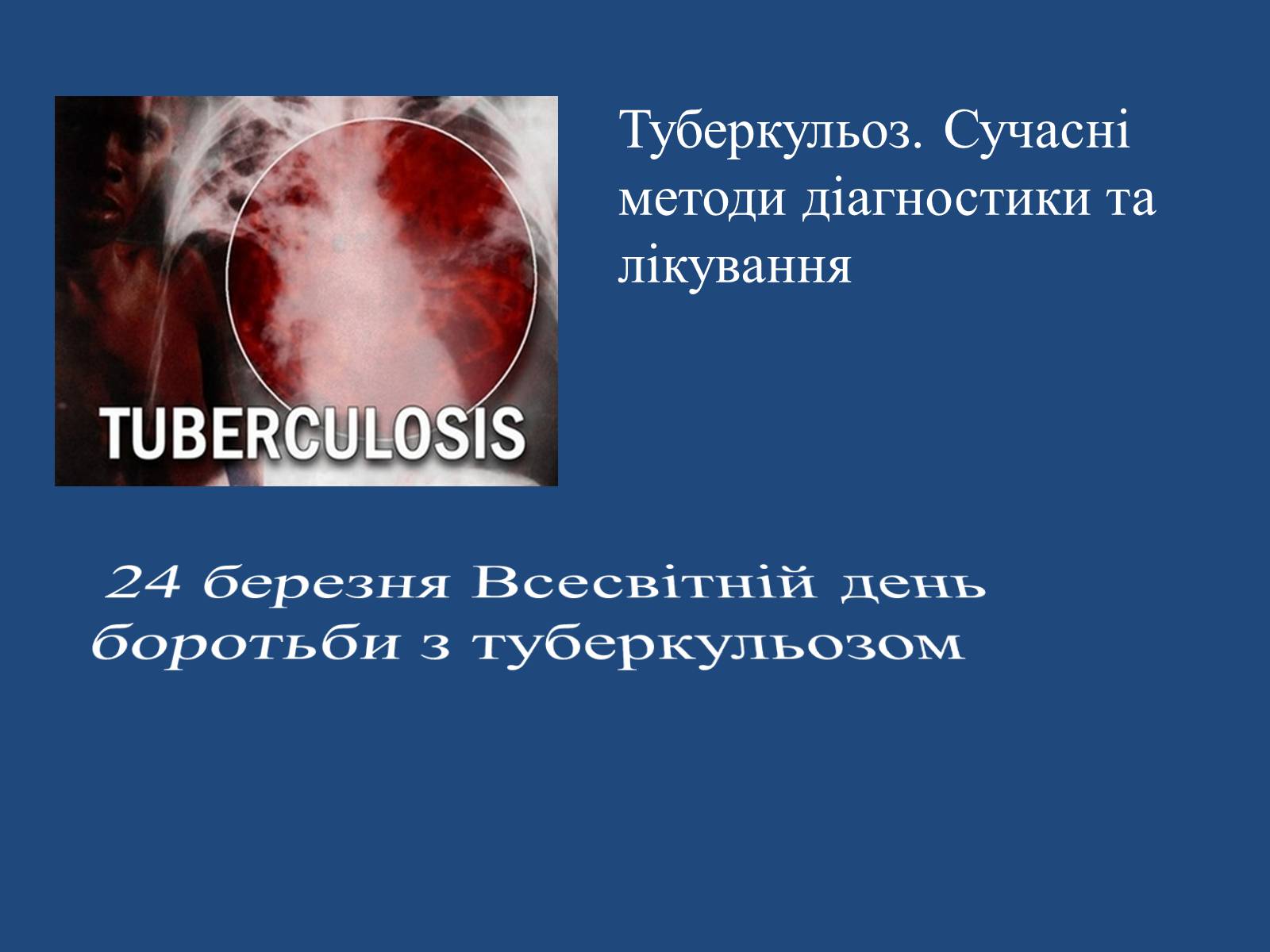Презентація на тему «Туберкульоз. Сучасні методи діагностики та лікування» - Слайд #1