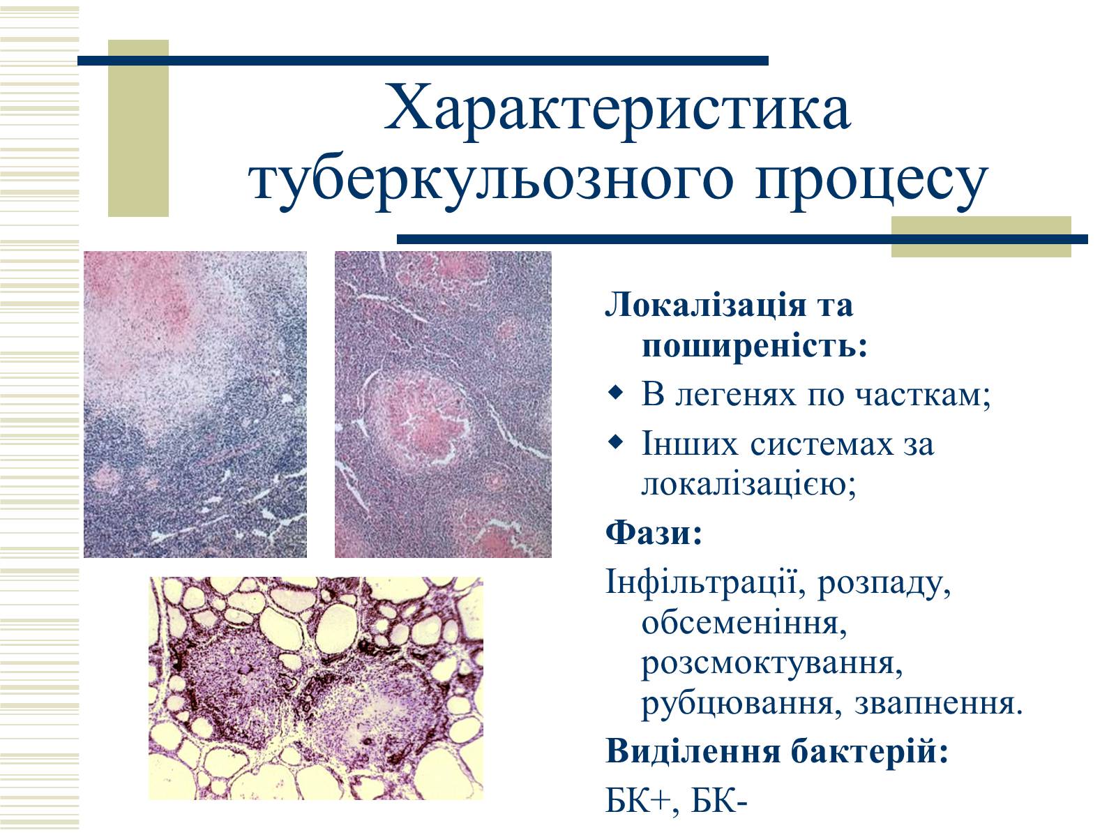 Презентація на тему «Патологічна анатомія туберкульозу» - Слайд #6