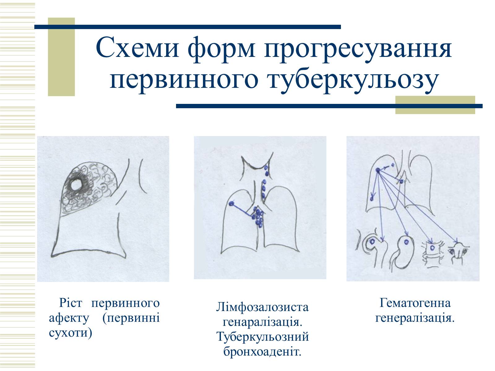 Презентація на тему «Патологічна анатомія туберкульозу» - Слайд #11