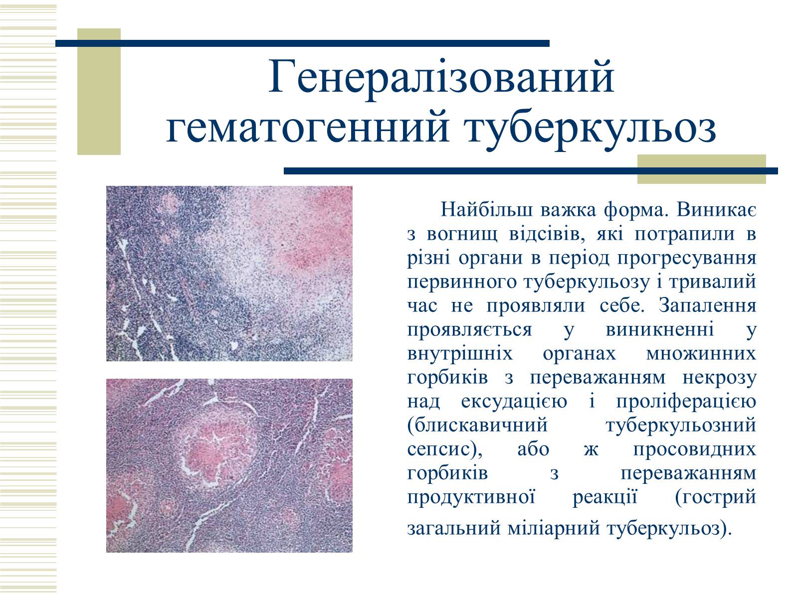 Презентація на тему «Патологічна анатомія туберкульозу» - Слайд #17