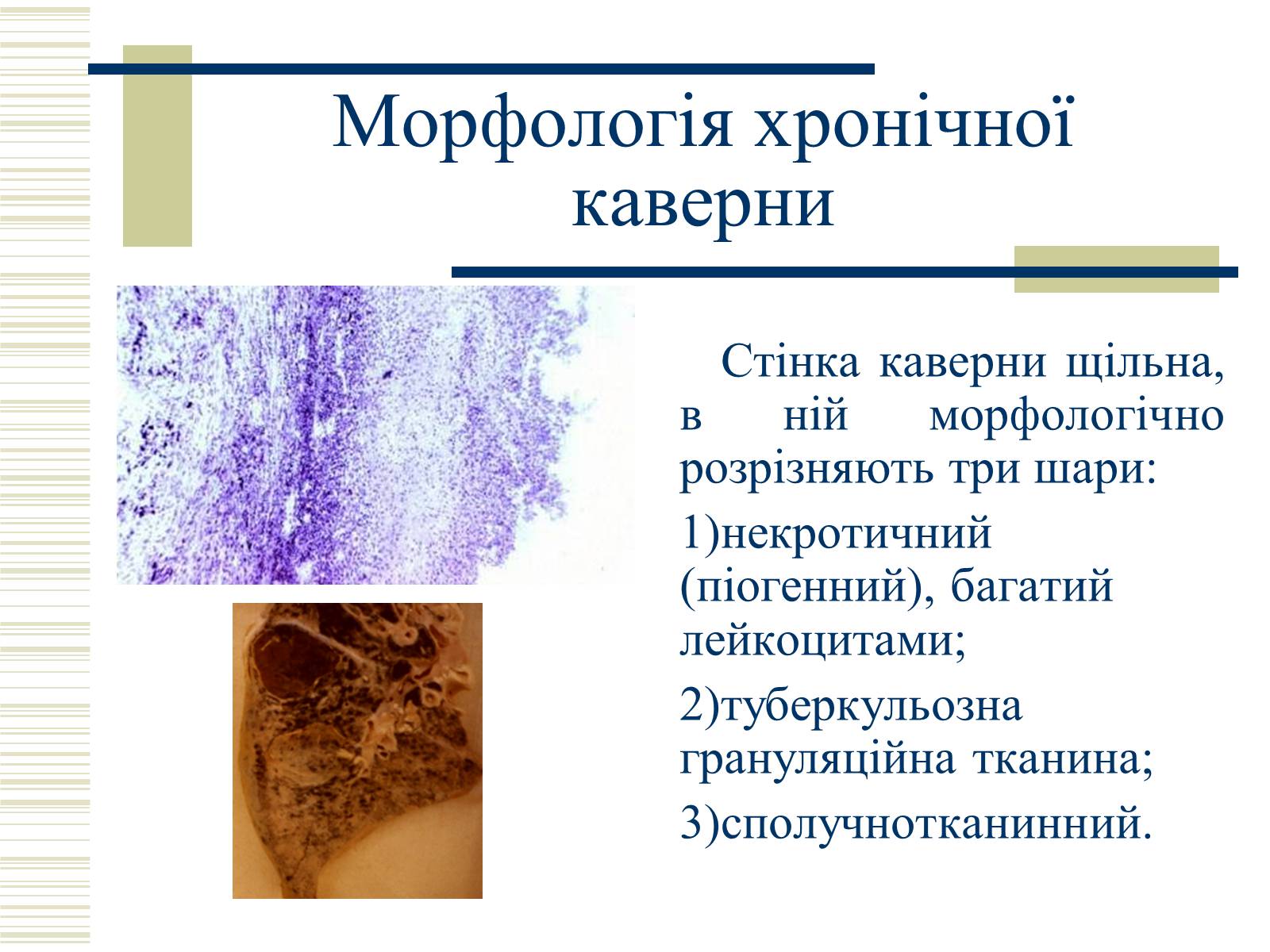 Презентація на тему «Патологічна анатомія туберкульозу» - Слайд #28
