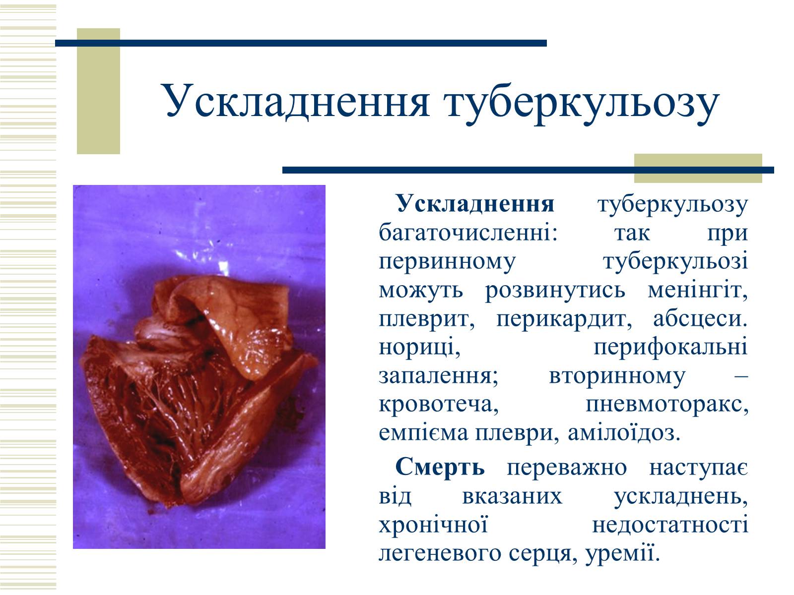 Презентація на тему «Патологічна анатомія туберкульозу» - Слайд #29