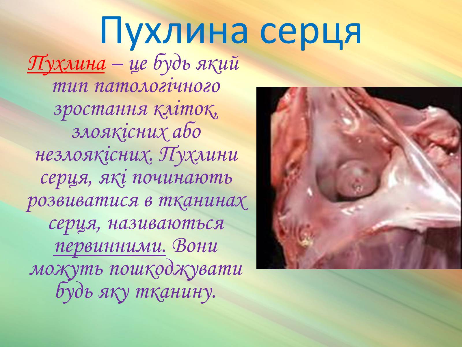 Презентація на тему «Захворювання органів кровообігу» - Слайд #18