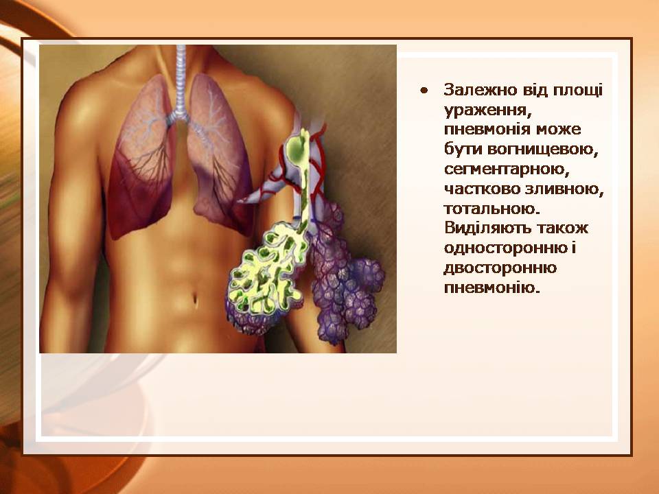 Презентація на тему «Пневмонія» - Слайд #7