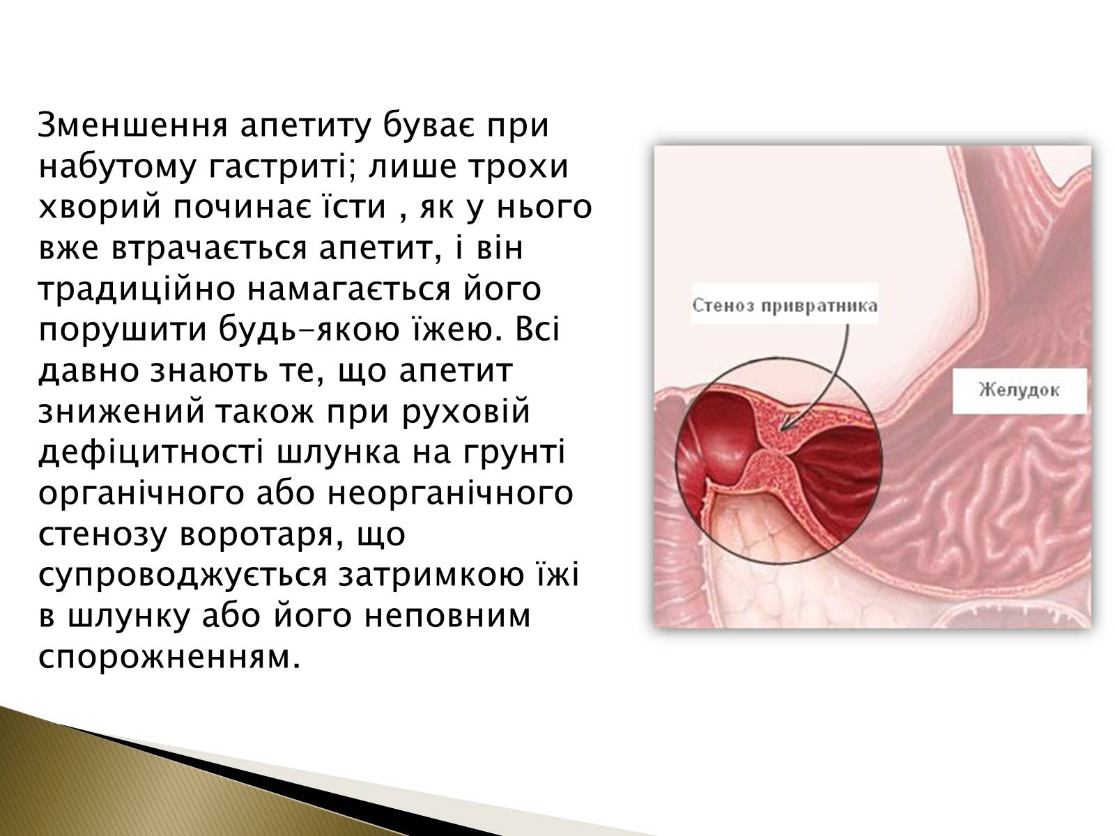 Презентація на тему «Ознаки захворювань шлунка» - Слайд #7