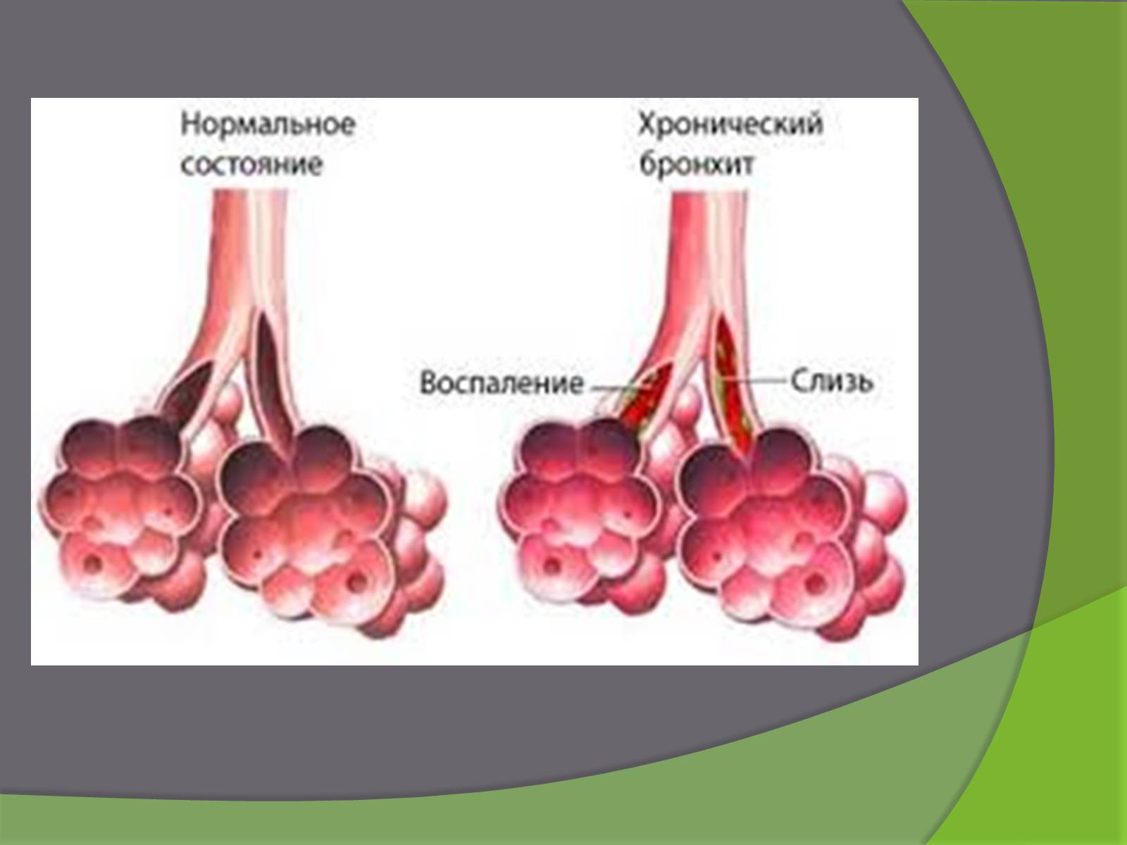 Хронический бронхит презентация