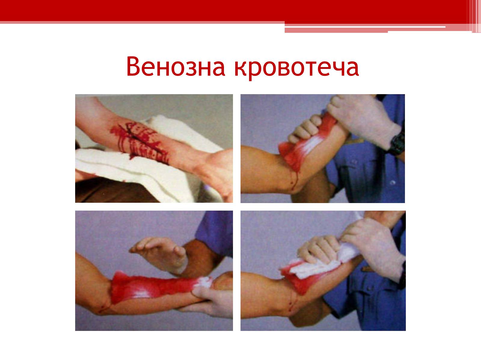 Презентація на тему «Перша допомога при кровотечах» (варіант 1) - Слайд #7